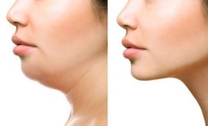 Causes Of Double Chin And How To Get Rid Of It