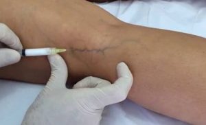 Why do Varicose Veins Appear, and how do you Get Rid of them?