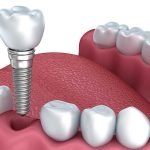 Benefits of Bridges and Dentists